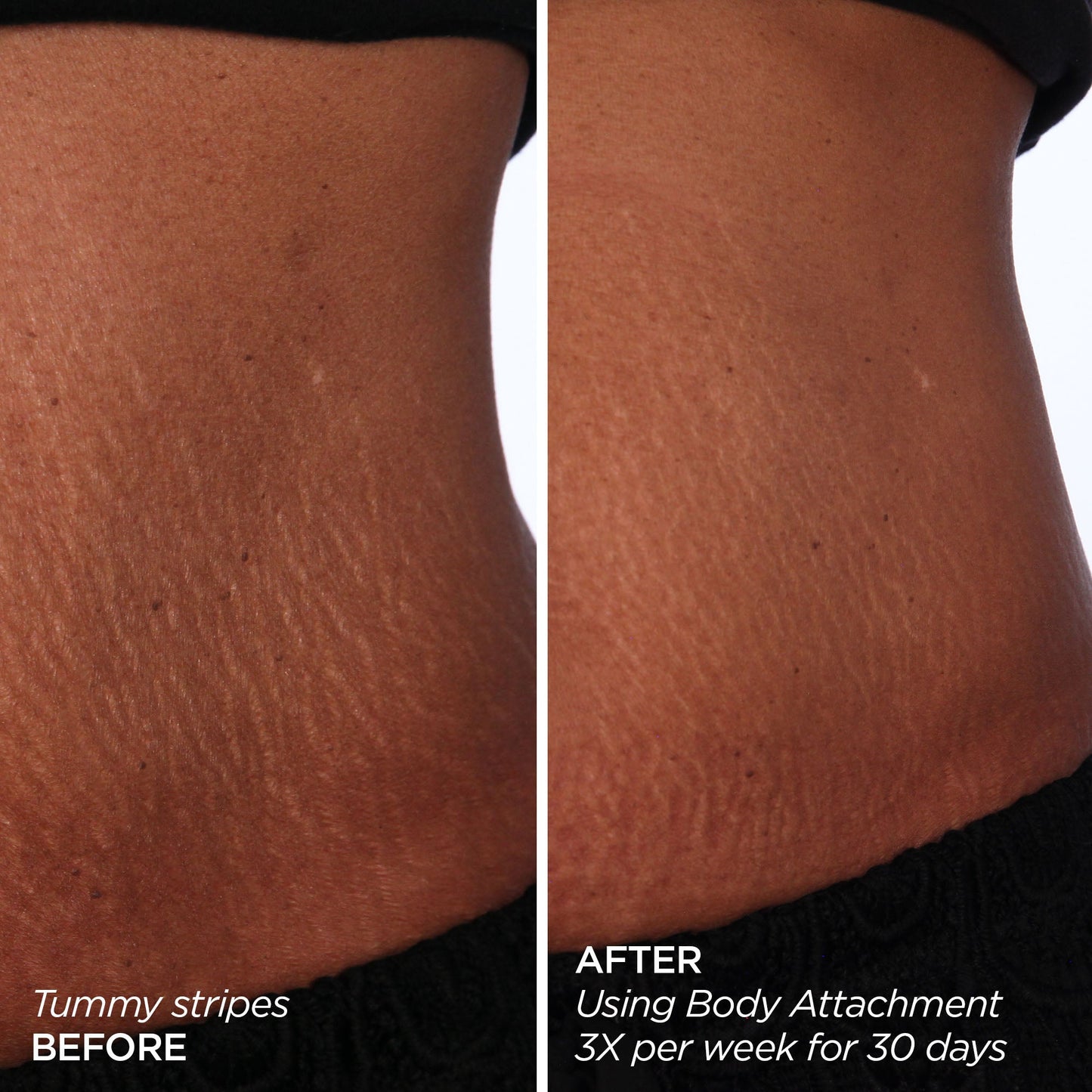 GloPRO® BODY MicroTip™ Attachment Head BeautyBio