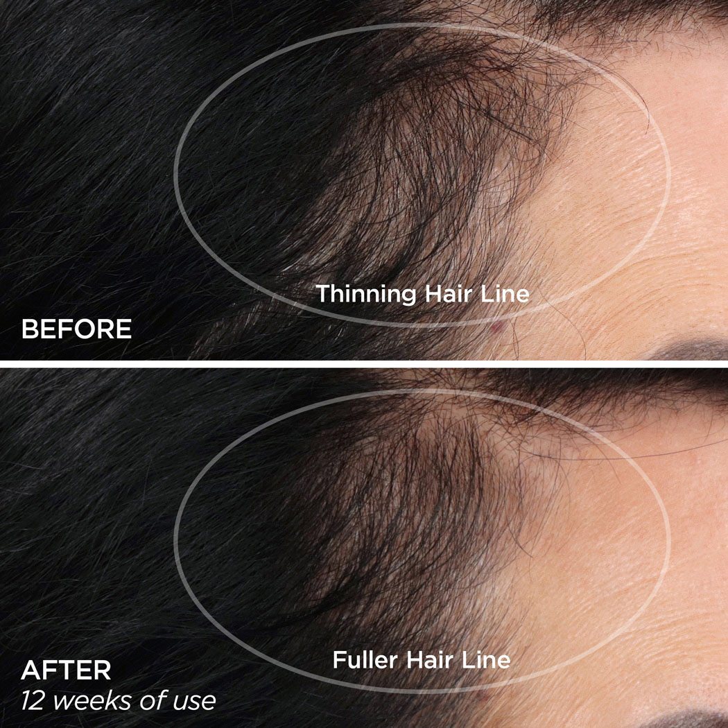 GloPRO® SCALP Attachment BeautyBio 