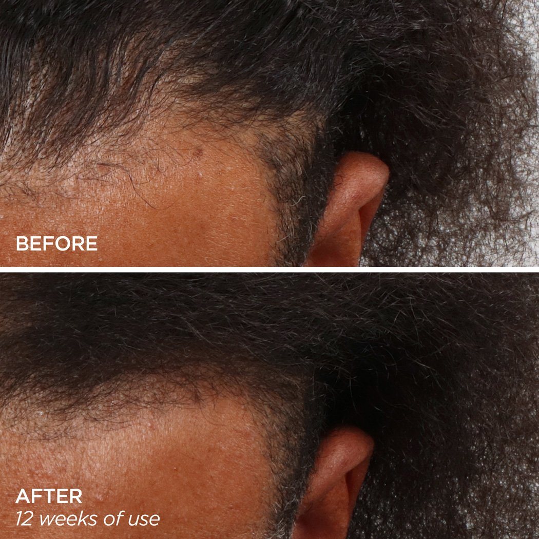 Men's Scalp & Beard hair loss treatment Helps Thicken Receding Hairlines
