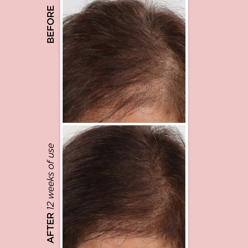 Rose Gold Rejuvenating Scalp + Fuller Hair Therapy Set + Pack N' Glo Haircare BeautyBio 