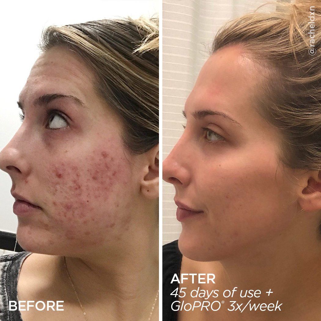R45 | Retinol That Helps With Acne | Before and After